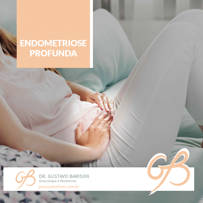 Endometriose profunda