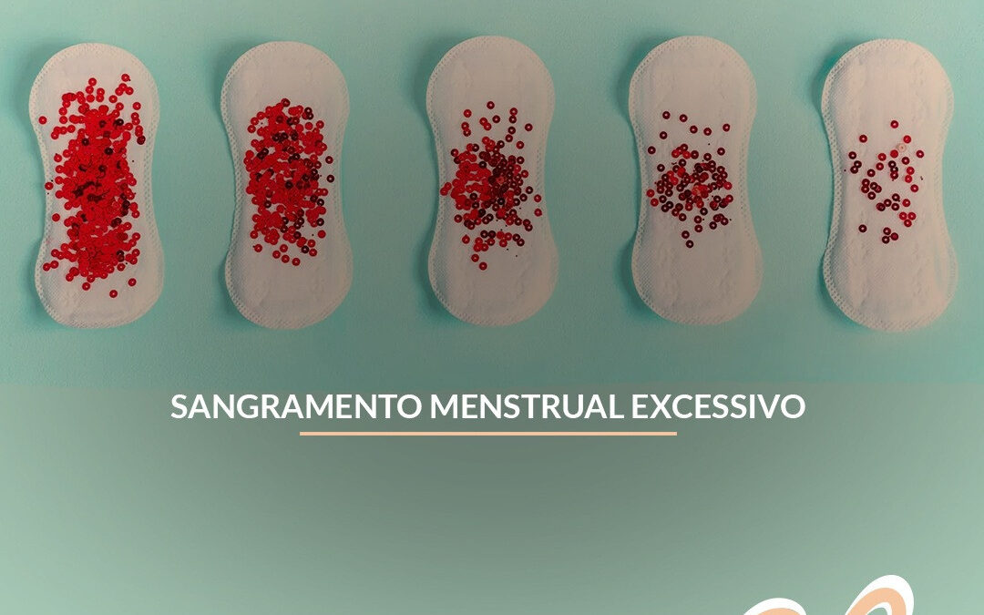 Sangramento em excesso na menstruação pode ser mioma; entenda