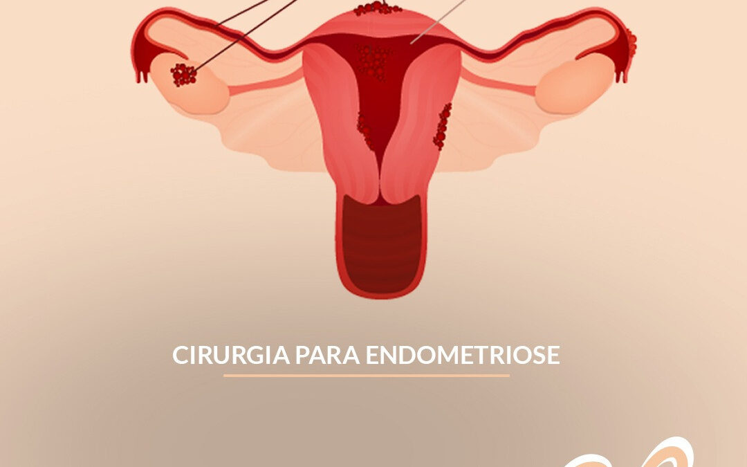 Cirurgia para Endometriose – no que consiste?⠀