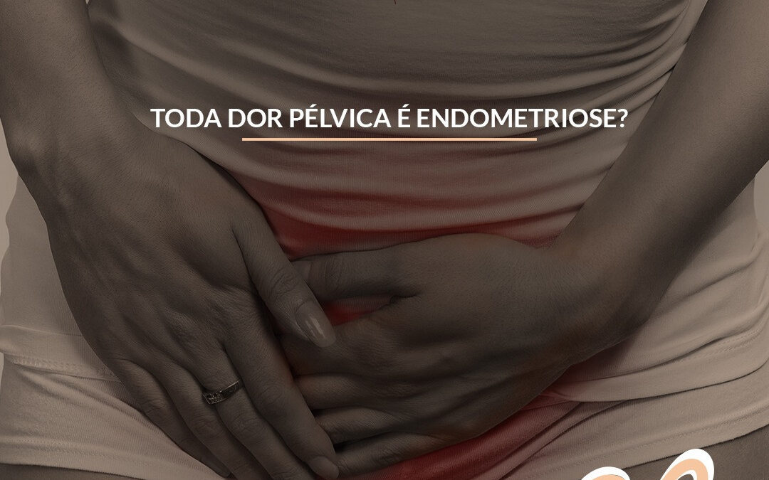 Toda dor pélvica é endometriose?